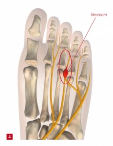 Mortons Neuroom Oorzaak Behandeling Shockwave Nl