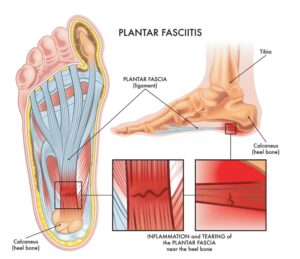 fasciitis plantaris