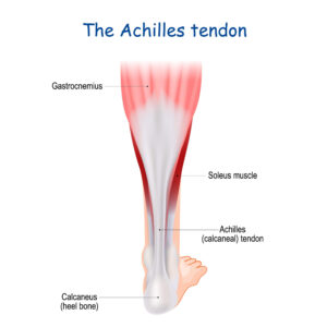 ontsteking aanhechting achillespees