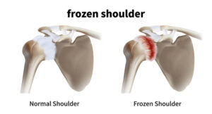 frozen shoulder symptomen